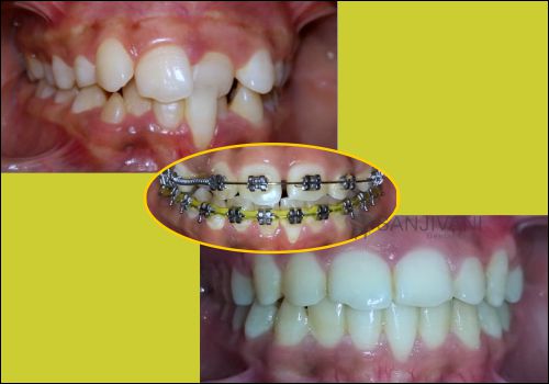 Dental Treatment 3 braces treatment in rajkot