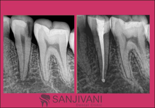 Dental Treatment 8 rct dentist in rajkot