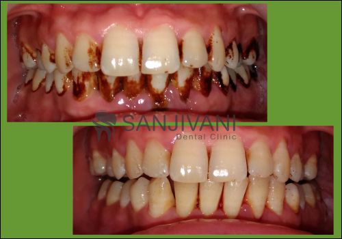 Dental Treatment 9 teeth cleaning rajkot