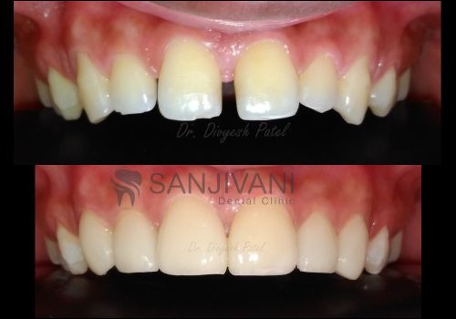 Dental Treatment 11 teeth veneer dentist in rajkot