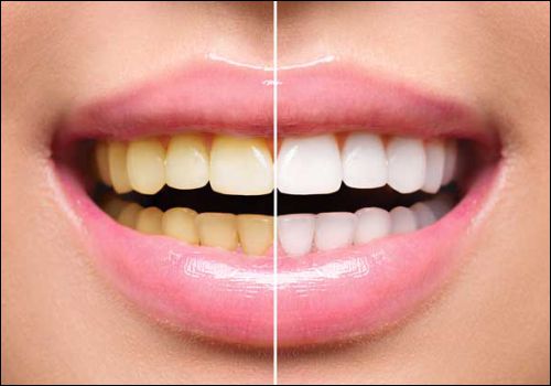 Dental Treatment 7 teeth whitening in rajkot