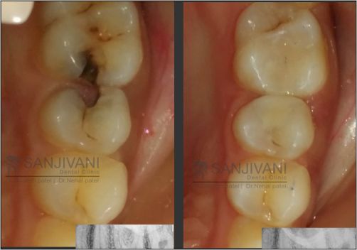 Dental Treatment 4 tooth filling in rajkot