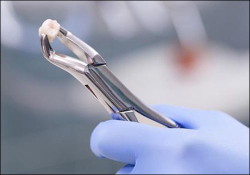 Dental Treatment 14 tooth removal in rajkot