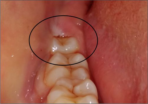 Dental Treatment 5 wisdom tooth treatment
