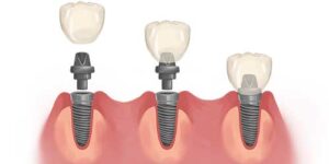 ડેન્ટલ ઈમ્પ્લાન્ટ - ગુમાવેલા દાંત ફરીથી બેસાડવા માટેનો શ્રેષ્ઠ ઉપાય / what is dental implant 3 dental-implant-steps rajkot