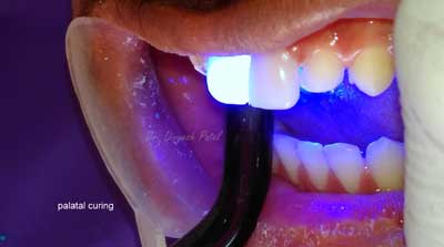 Get celebrity like white teeth with dental veneers 4 dental veneer procedure