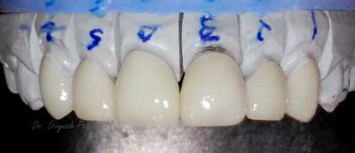 Get celebrity like white teeth with dental veneers 3 emax dental veneer rajkot