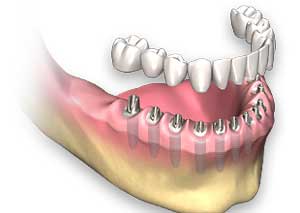full mouth imlant in rajkot