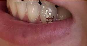 Diamond on teeth-Sparkle your smile with Teeth Jewellery 3 name on teeth by dentist