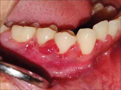 gum-pop-up-in-pragnancy