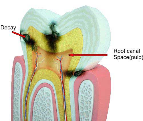 root-canal-decay