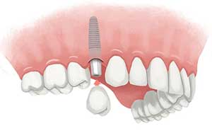 single dental implant in rajkot