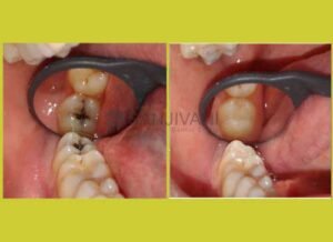 Dental Filling