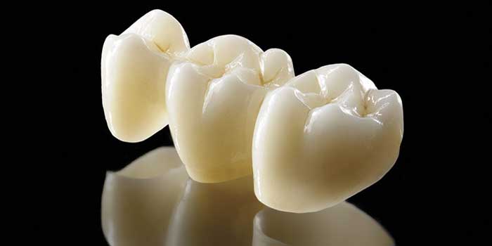 Dental Bridge Treatment in Rajkot Cost, Advantage and Aftercare 5 dental-bridge