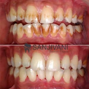 red-yellow-stain-on-teeth