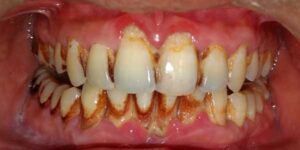 શું તમને પેઢાં નો રોગ પાયોરીયા તો નથી ને ? જાણો તેના કારણો અને ઉપાય . 4 gum-pain-rajkot