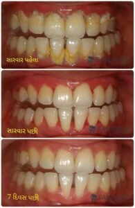 gum-treatment-rajkot