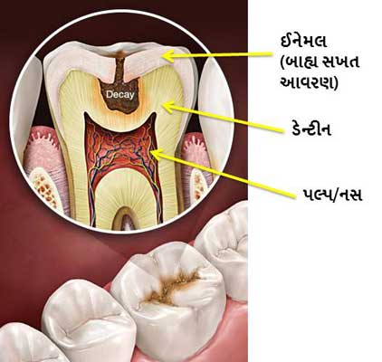dental caries rajkot