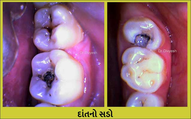 dental-decay-in-rajkot