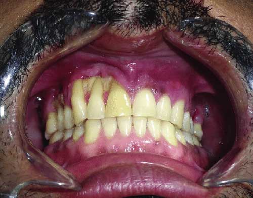 mucormycosis-in-rajkot-sanjivani-dental-clinic