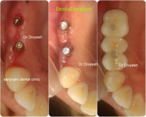 ડેન્ટલ ઈમ્પ્લાન્ટ - ગુમાવેલા દાંત ફરીથી બેસાડવા માટેનો શ્રેષ્ઠ ઉપાય / what is dental implant 7 4 (2)