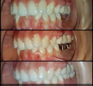 ડેન્ટલ ઈમ્પ્લાન્ટ - ગુમાવેલા દાંત ફરીથી બેસાડવા માટેનો શ્રેષ્ઠ ઉપાય / what is dental implant 8 4.5