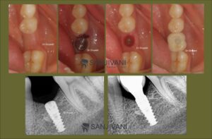 Dental Implants cost in Rajkot – Sanjivani Dental Hospital 3 dental implant