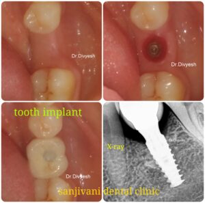 ડેન્ટલ ઈમ્પ્લાન્ટ - ગુમાવેલા દાંત ફરીથી બેસાડવા માટેનો શ્રેષ્ઠ ઉપાય / what is dental implant 10 9 - Copy