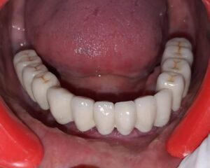 ડેન્ટલ ઈમ્પ્લાન્ટ - ગુમાવેલા દાંત ફરીથી બેસાડવા માટેનો શ્રેષ્ઠ ઉપાય / what is dental implant 11 FB_IMG_1537685545752