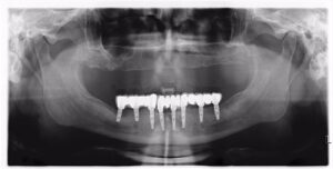 Dental Implants cost in Rajkot – Sanjivani Dental Hospital 4 IMG 20170626 WA0069