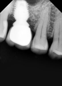 ડેન્ટલ ઈમ્પ્લાન્ટ - ગુમાવેલા દાંત ફરીથી બેસાડવા માટેનો શ્રેષ્ઠ ઉપાય / what is dental implant 13 IMG-20171003-WA0023