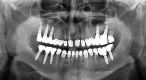 Dental Implants cost in Rajkot – Sanjivani Dental Hospital 5 Panoramic X ray Zirconia crown bridge on implant after Jean Denise Vanhoutte MDental Clinic Hungary