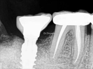 ડેન્ટલ ઈમ્પ્લાન્ટ - ગુમાવેલા દાંત ફરીથી બેસાડવા માટેનો શ્રેષ્ઠ ઉપાય / what is dental implant 15 R15