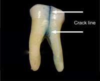 crack-tooth- sensitivity
