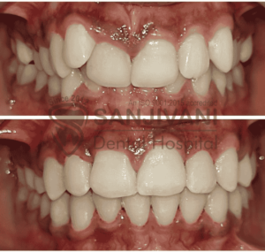 Aligner Treatment dentist in Rajkot