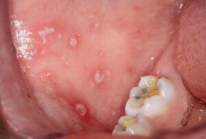 viral ulcer