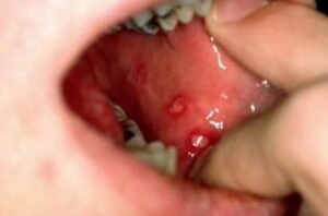 mouth ulcer