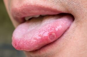 mouth ulcer on tongue