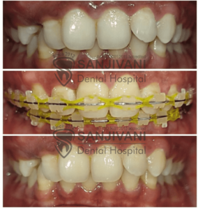 braces-treatment-in-rajkot