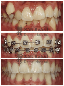 braces-treatment-in-rajkot
