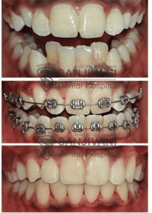 braces-treatment-in-rajkot