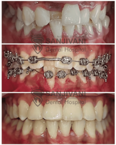 braces-treatment-in-rajkot