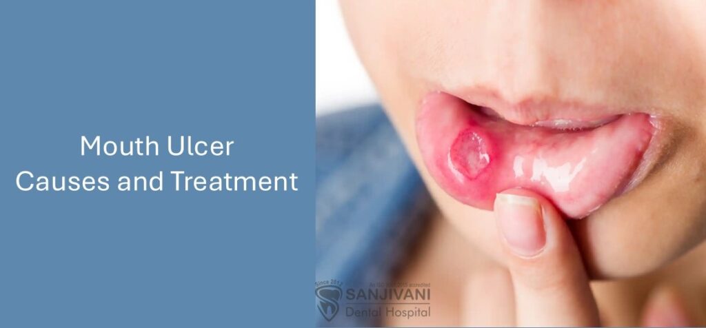 mouth ulcer treatment
