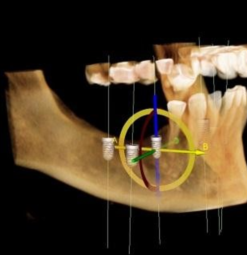 Sanjivani Dental Clinic- Rajkot, Gujarat | Dentist in Rajkot 32 3D digital implant placement