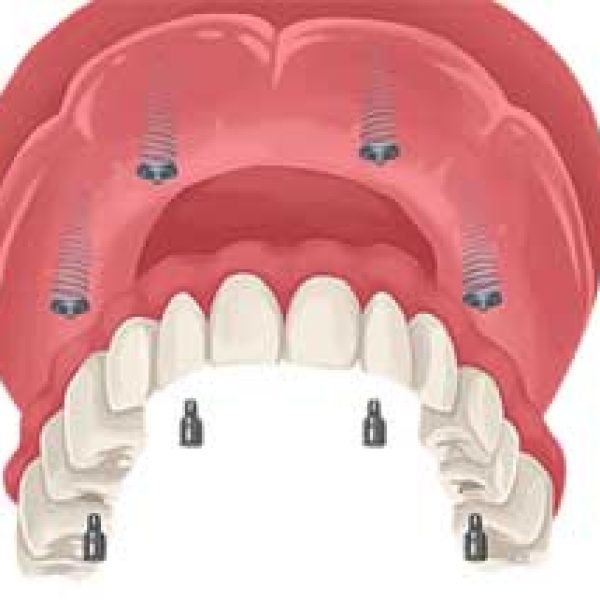 implant-supported-dentures