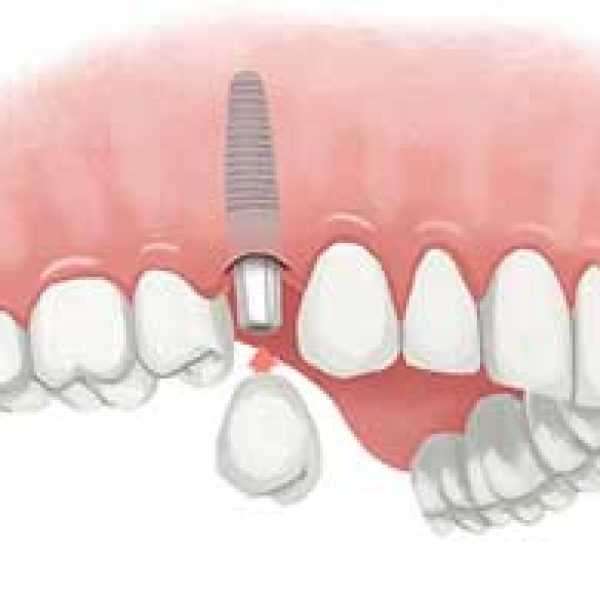 single-dental-implant-in-rajkot