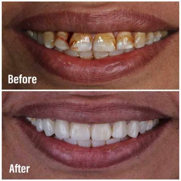 yellow-stain-treatment-emax-veneer